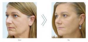 Botox en fillers